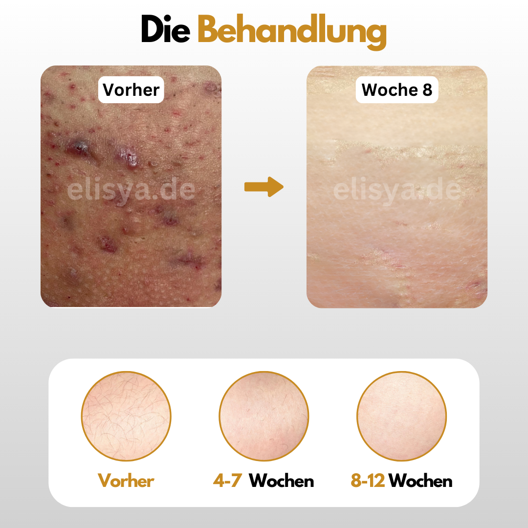 Dauerhafte Entfernung von Körper & Intimbehaarung - Elisya®